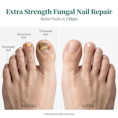 Nighttime Antifungal Pen Extra Strength: 1% Tolnaftate Tea Tree Oil| #1