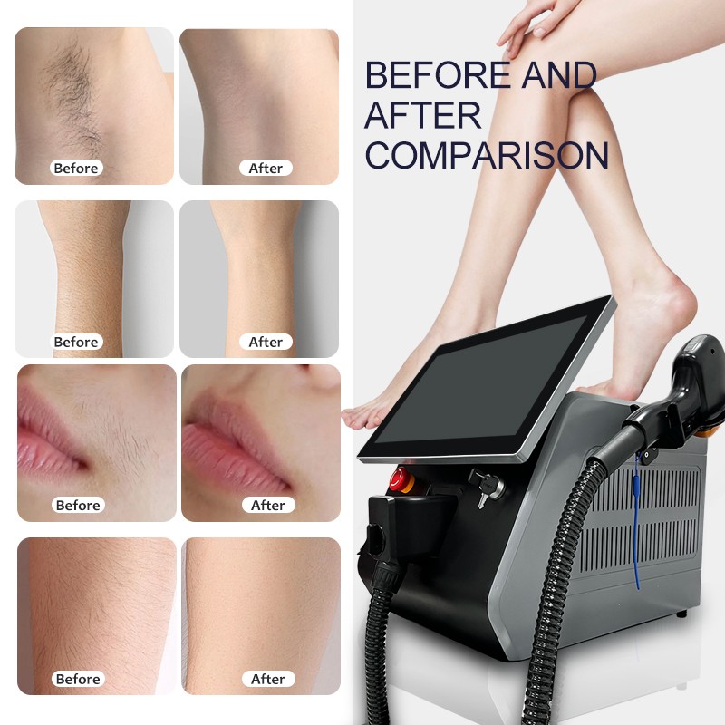 10bar Ice Titanium 755 808 940 1064nm Permanent Diode Laser hair removal Machine