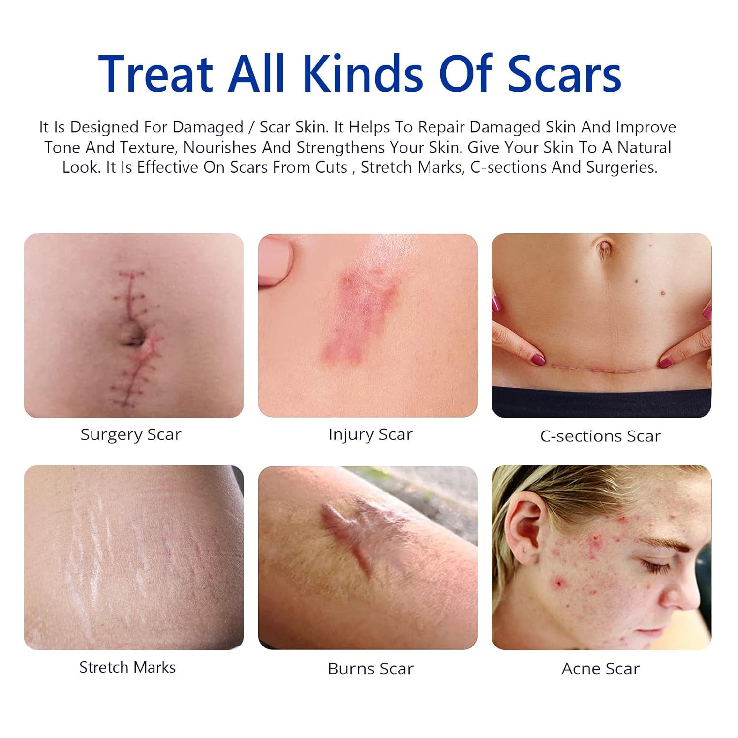 Scar Cream, Scar Removal Cream – Advanced Scar Cream for Surgical Scars, Acne Sc