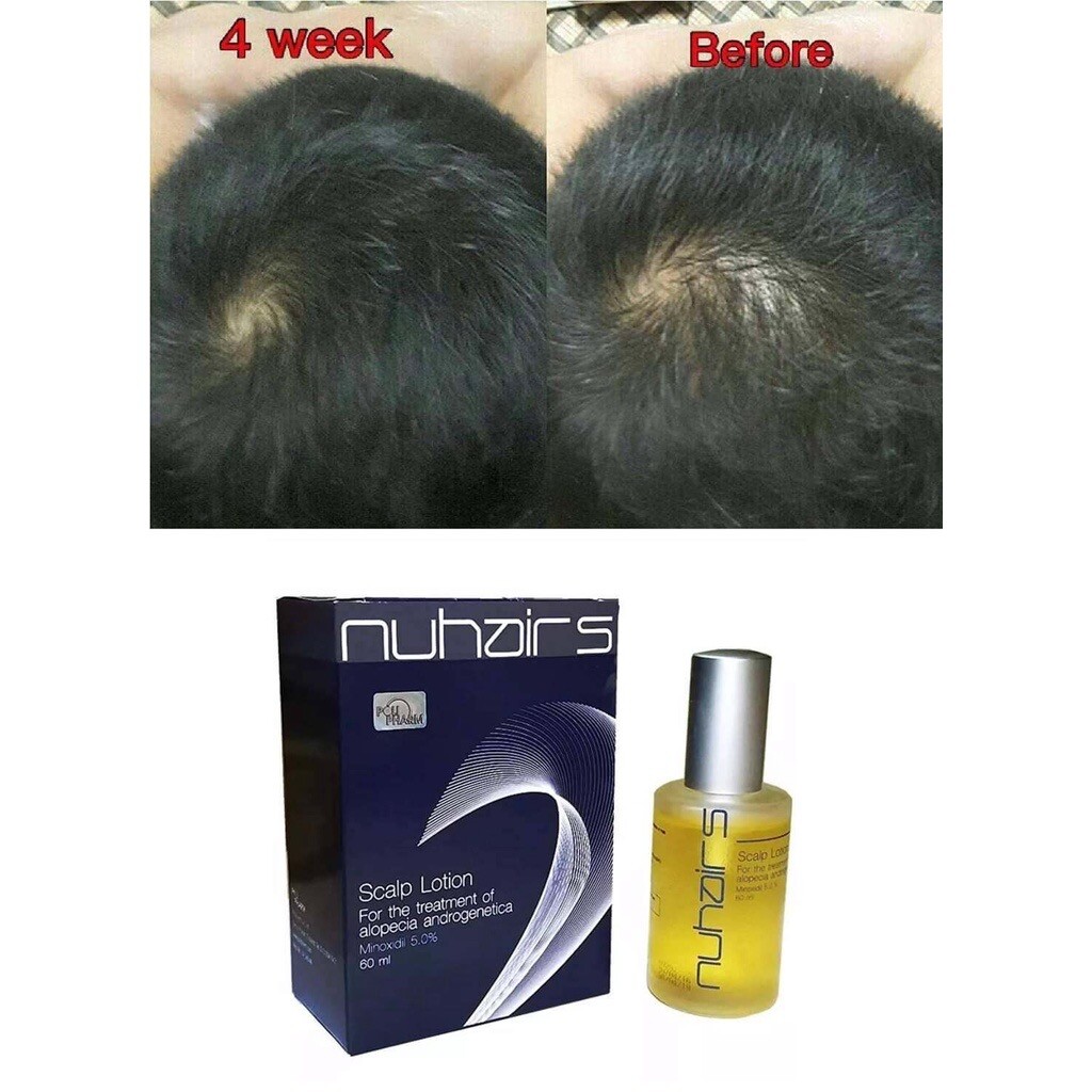 2x Nuhair 5% Hair Lotion Help to Speed Up Hair Reduce Hair Loss Hair Regrowth