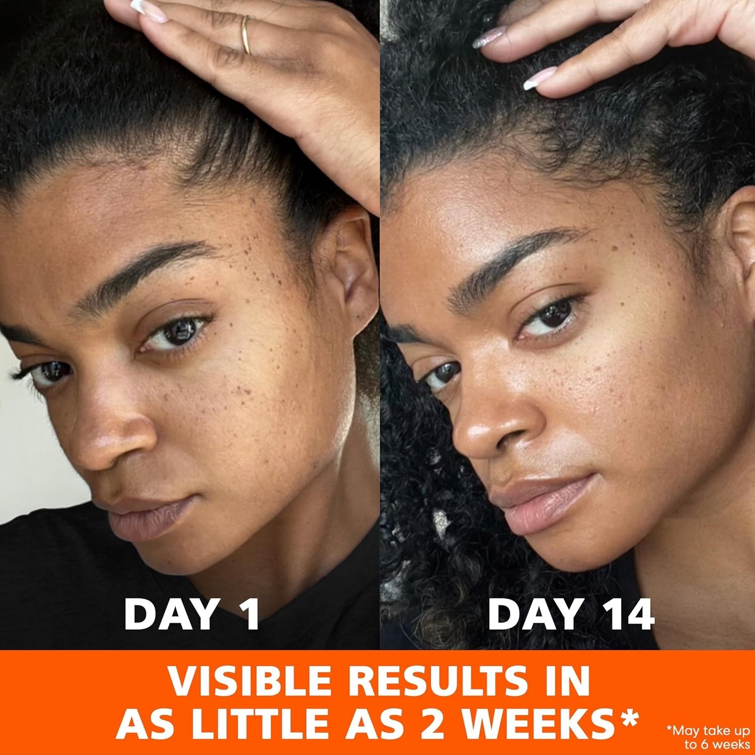 Age Spot Remover Face Body, Hands, Neck. Dark Spot Corrector Cream
