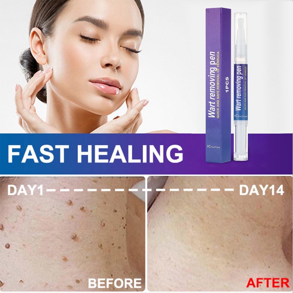 12 Hours Wart Remover Pen Skin Tag Mole Remover Eliminate Foot Corn Warts Unisex