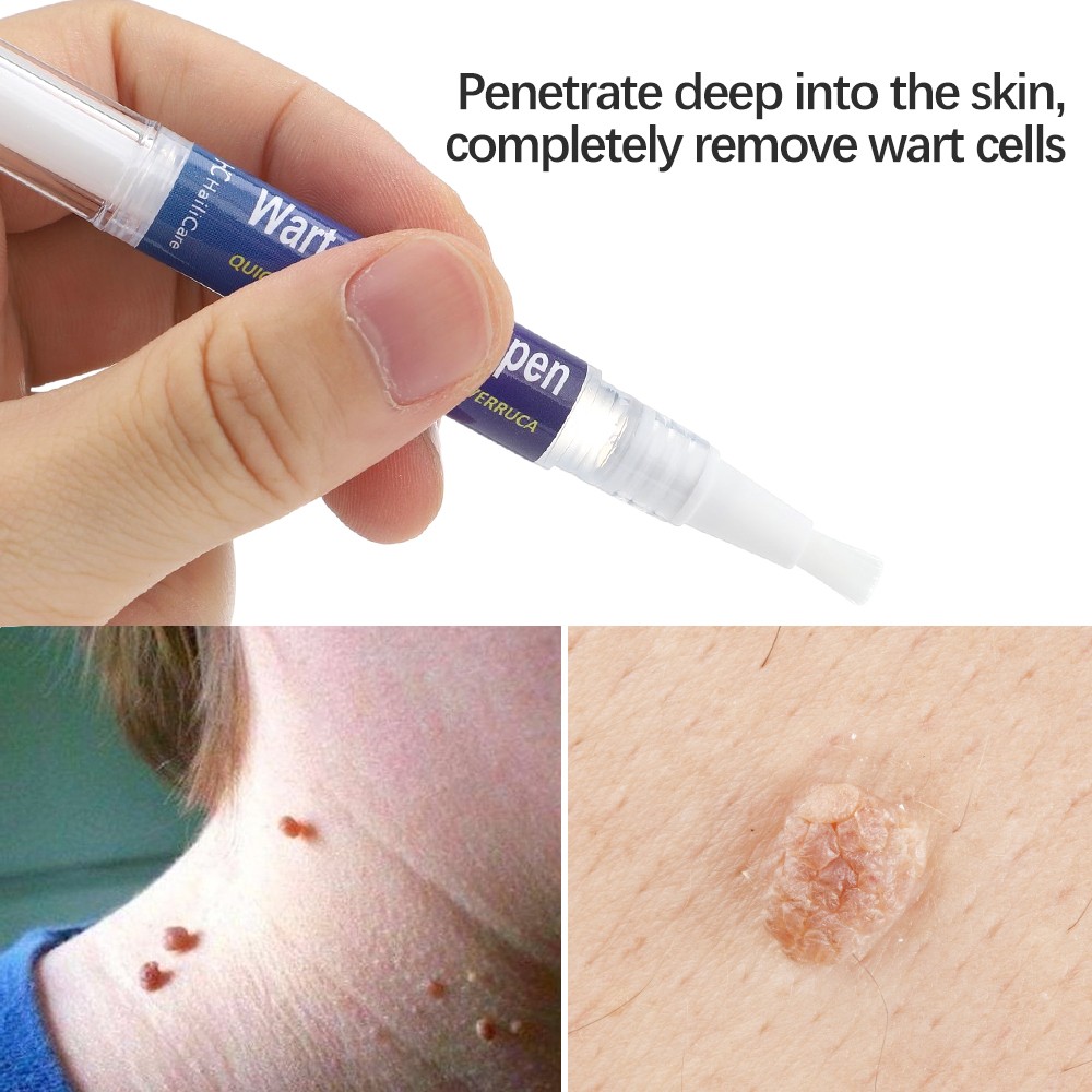 12 Hours Wart Remover Pen Skin Tag Mole Remover Eliminate Foot Corn Warts Unisex