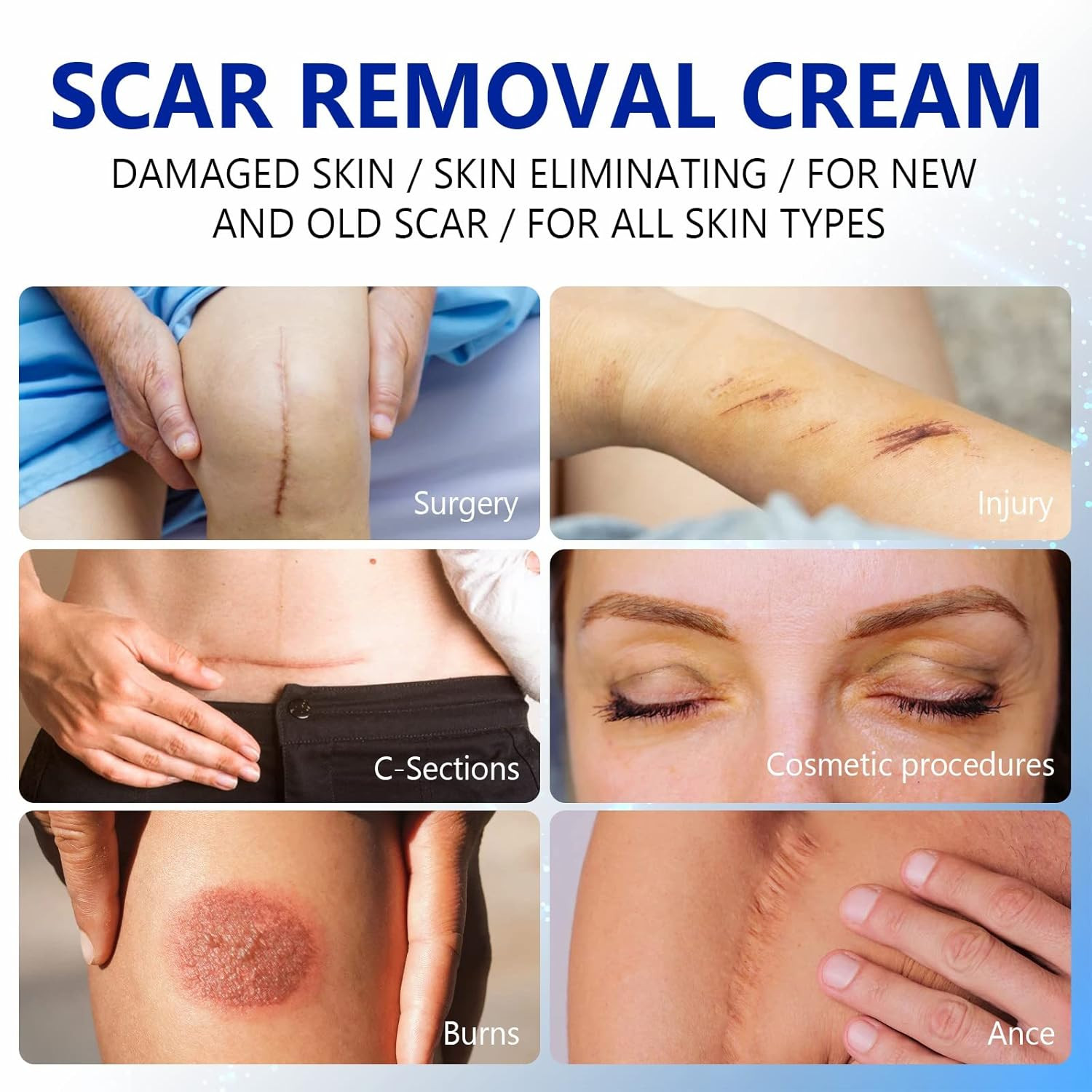Scar Cream, Scar Removal Cream – Advanced Scar Cream for Surgical Scars, Acne Sc