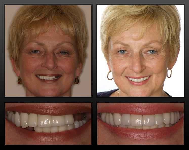 TEMPORARY TOOTH REPAIR or REPLACE KIT DIY makes 25-30 teeth *No Adhesive needed*