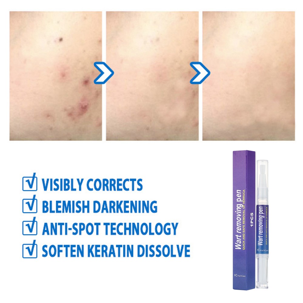12 Hours Wart Remover Pen Skin Tag Mole Remover Eliminate Foot Corn Warts Unisex