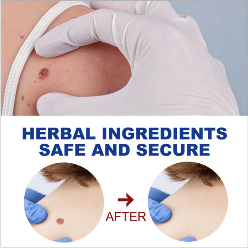 12 Hours Wart Remover Pen Skin Tag Mole Remover Eliminate Foot Corn Warts Unisex