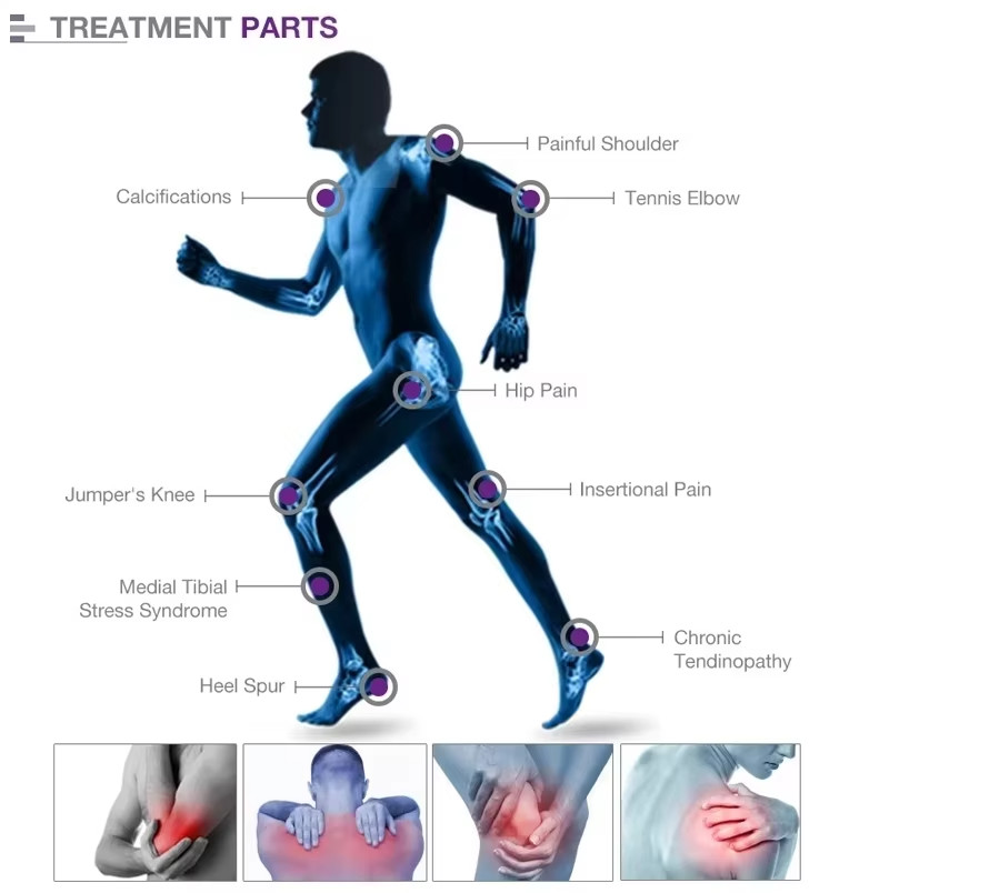 Focus Shockwave Eswt Focused Shock Wave Therapy Machine Pain Relief Physio