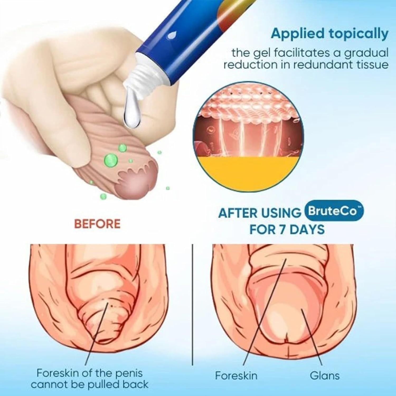 Redundant Prepuce Corrector Gel, Professional Redundant Prepuce Corrector Gel，Qu