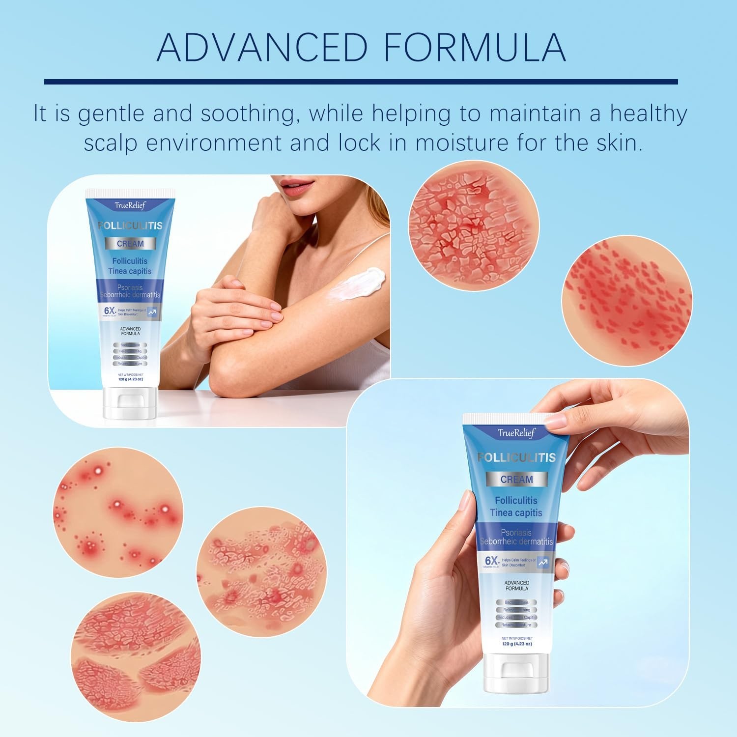Folliculitis Cream | Soothes & Helps Clear Bumps on Scalp, Face, Body & Butt …