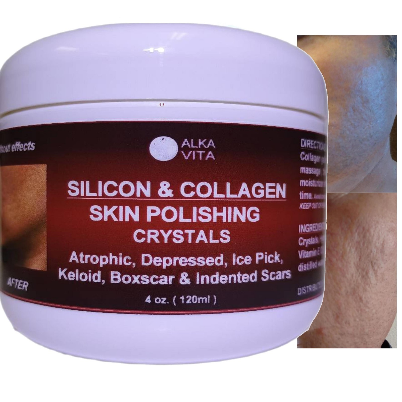 Acne Scars SILICON Skin Polishing Crystals Gel Indented Rolling Keloid ALKAVITA