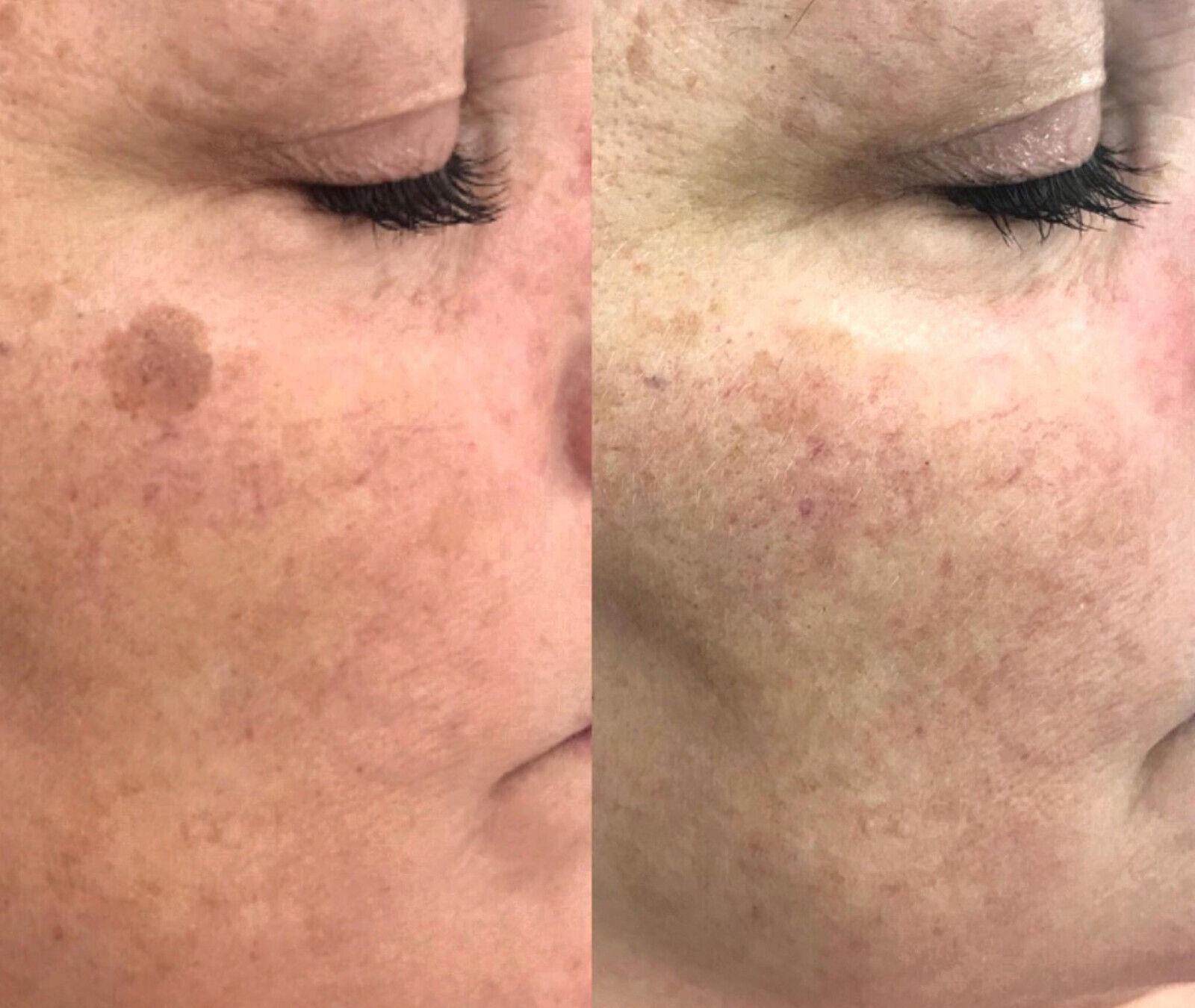 Sun Spot, Age Spot, Brown Spot, Dark Spot Corrector Treatment Remover: No Scam💙