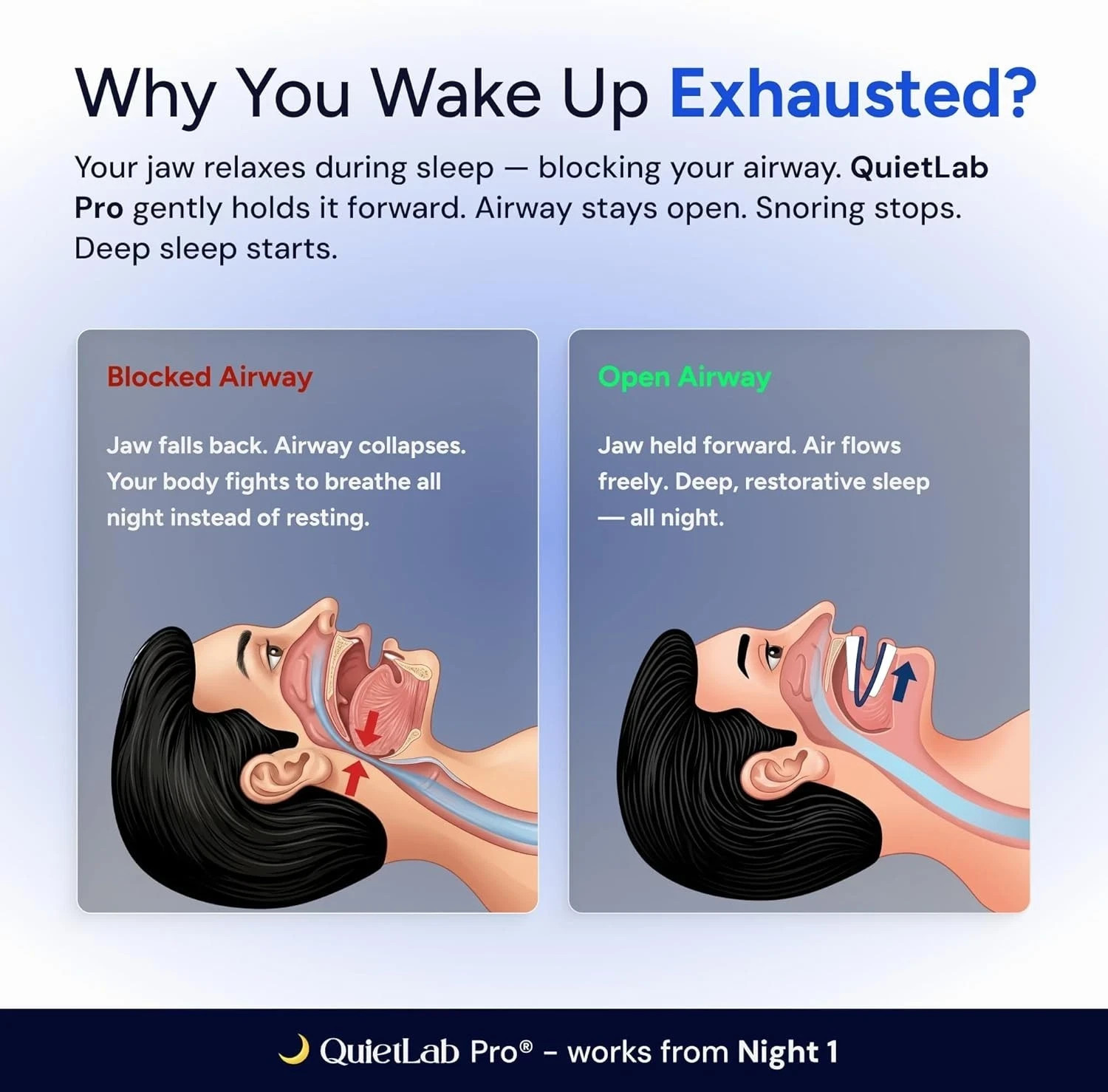 QuietLab Pro Adjustable Anti-Snoring Mouthpiece – BPA-Free Medical Free shiping)