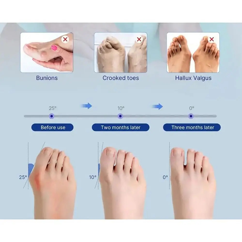 Ergonomic Bunion Corrector Adjustable Strap Reusable Toe Valgus Corrector