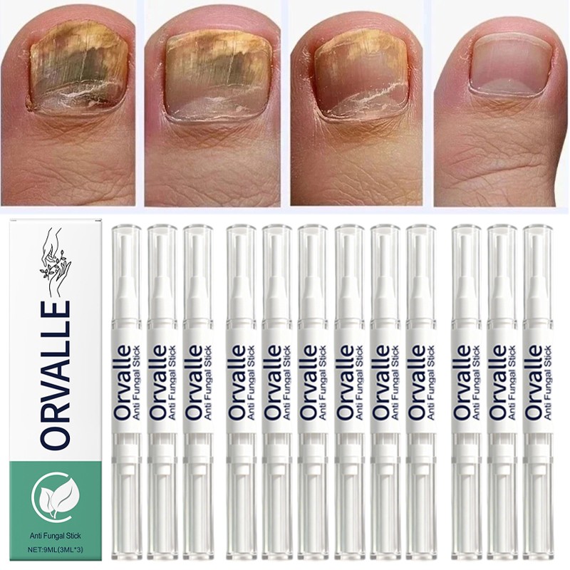 3-15X Orville Nail Fungus Pen Anti Fungus Infection Nail Care Repair Pen Toenail