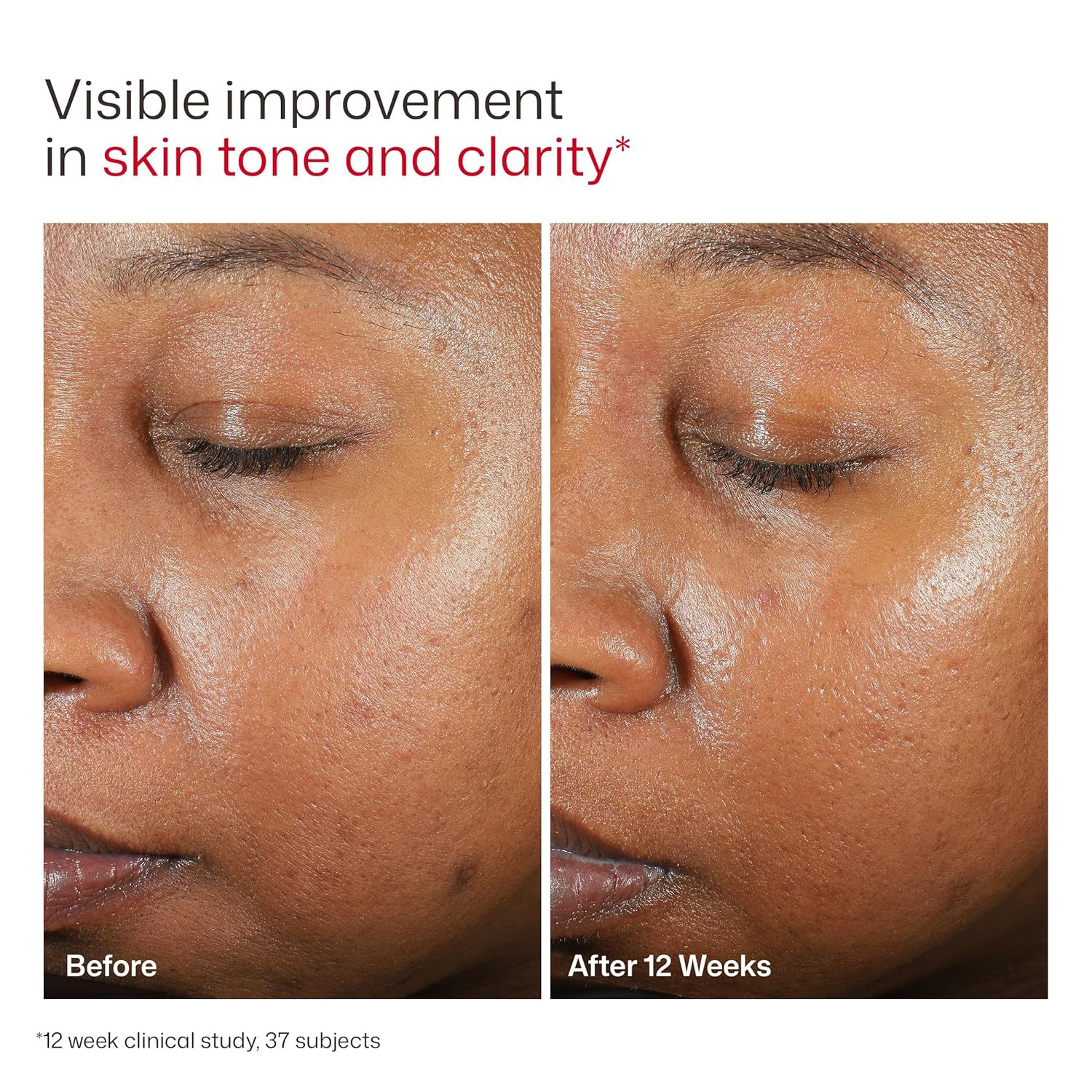Eltamd UV Clear Face Sunscreen SPF, Oil-Free Sunscreen with Zinc Oxide, Dermatol