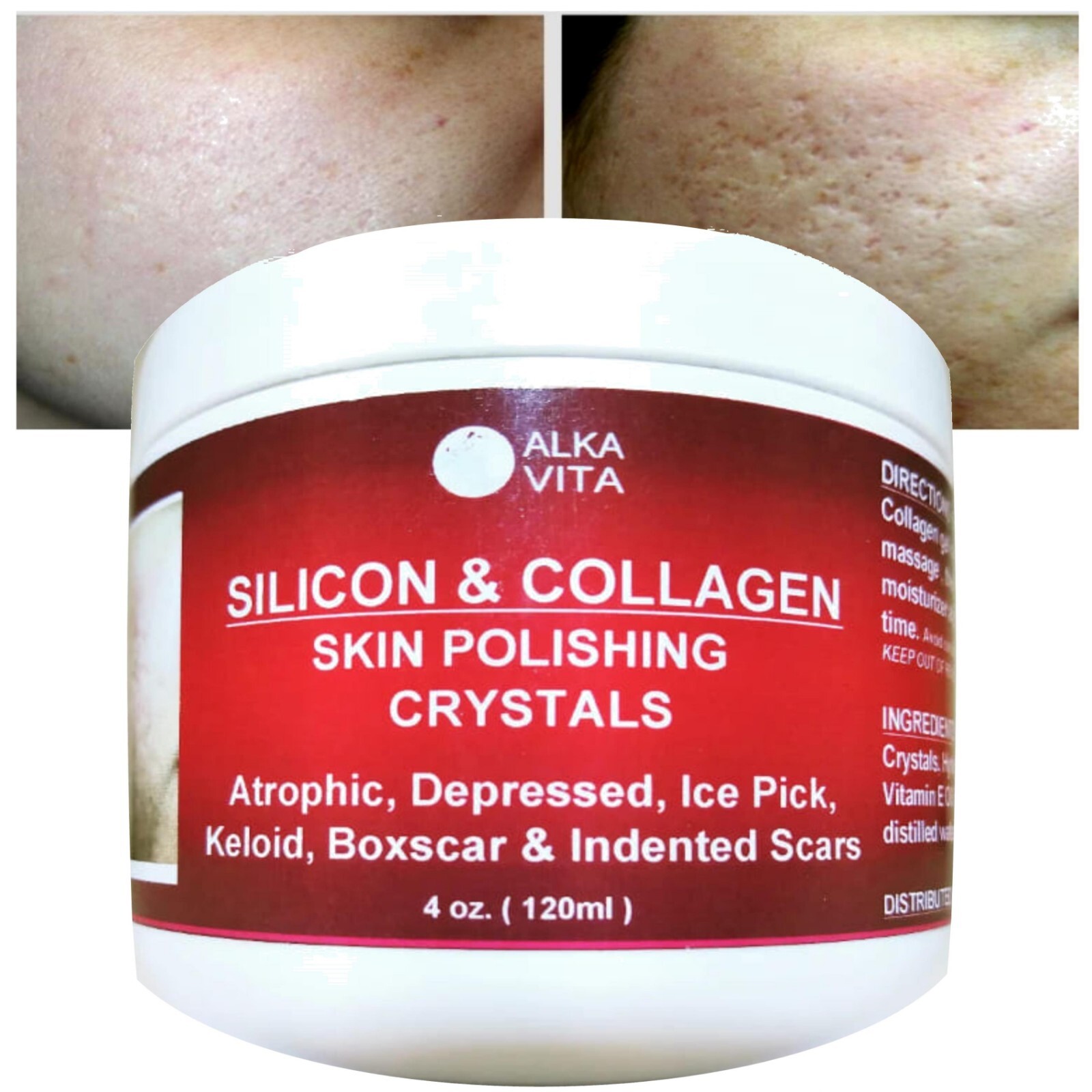 Acne Scars SILICON Skin Polishing Crystals Gel Indented Rolling Keloid ALKAVITA