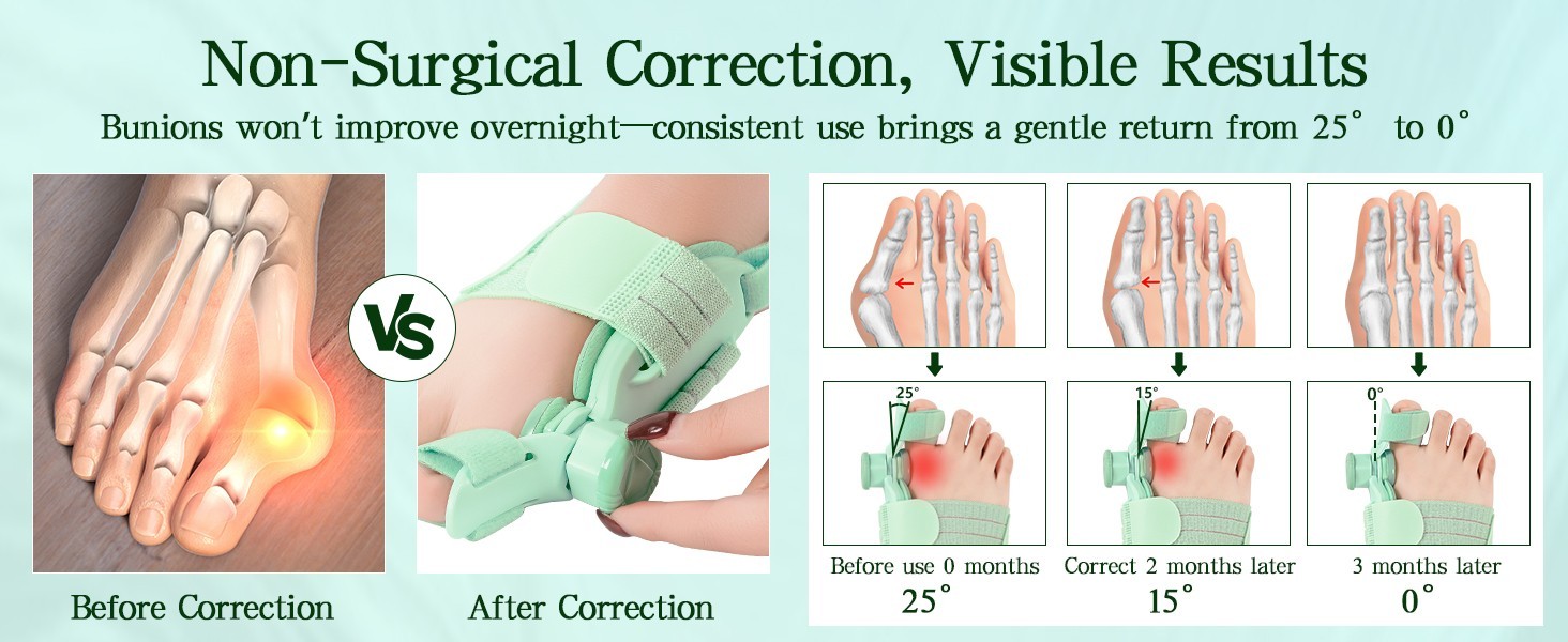 Bunion Fix Toe Valgus Corrector Big Toe Straightener Adjustable for Men & Women