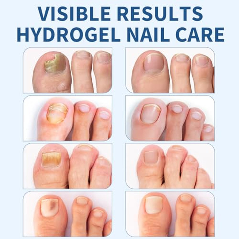 50PCS Toenail Nail Patches, 8-Hour Overnight Self-Adhesive Conditioning Stickers