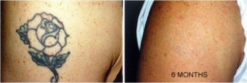 Permanent Tattoo Removal Cream