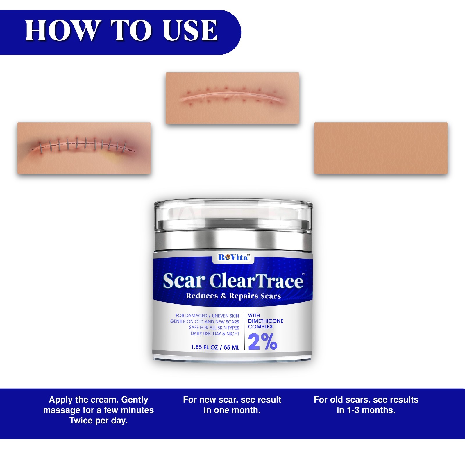 Scar Removal Cream – Old Scars Stretch Mark Spots, Surgery, Burn, Injury Scar