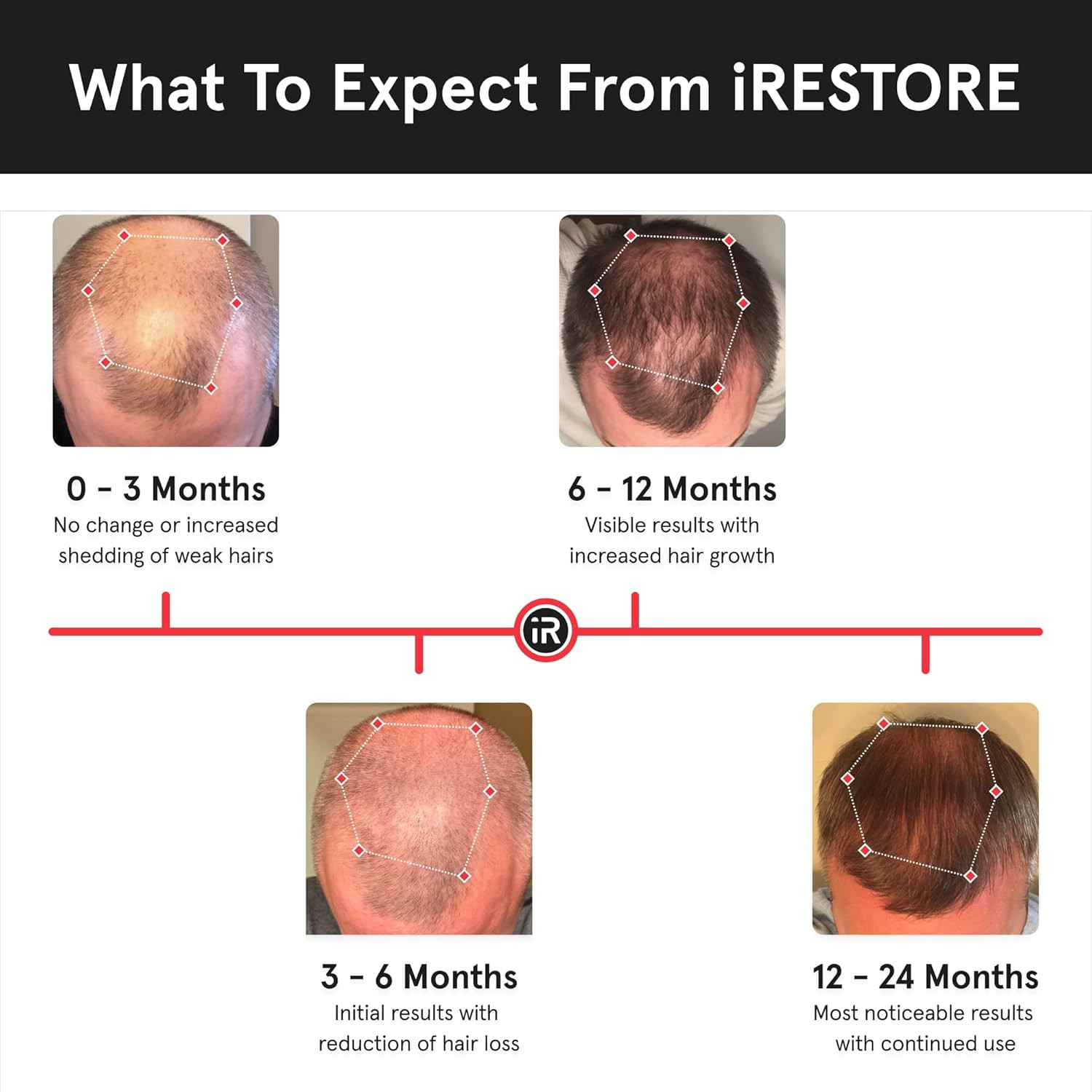 Irestore Essential – Laser Red Light Therapy for Hair Growth – FDA Cleared Hair