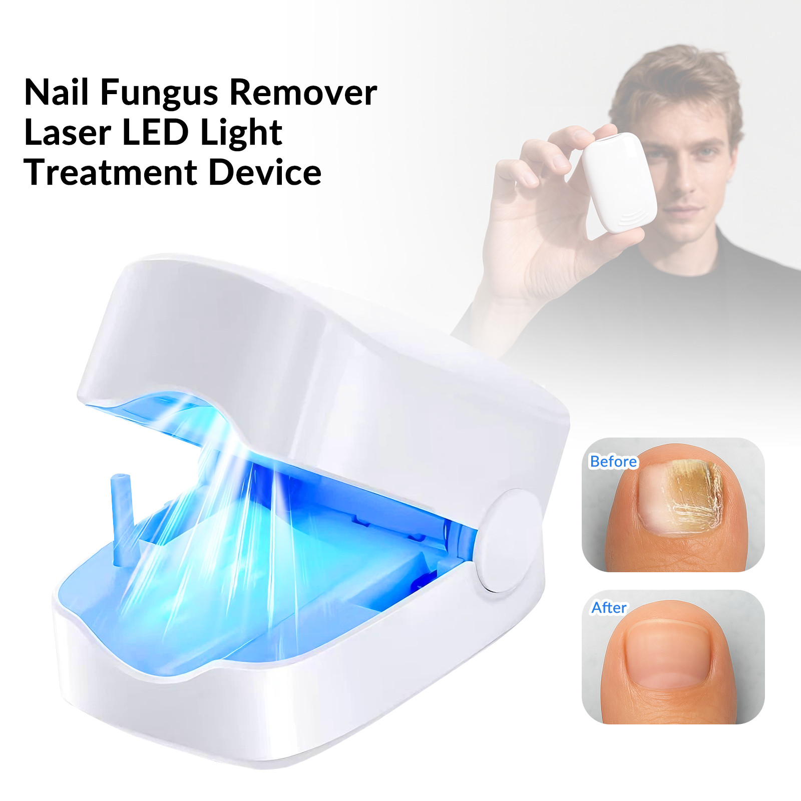 Nail Fungus Laser Physiotherapy Device 940nm 500nm for Toenail Fingernail Care
