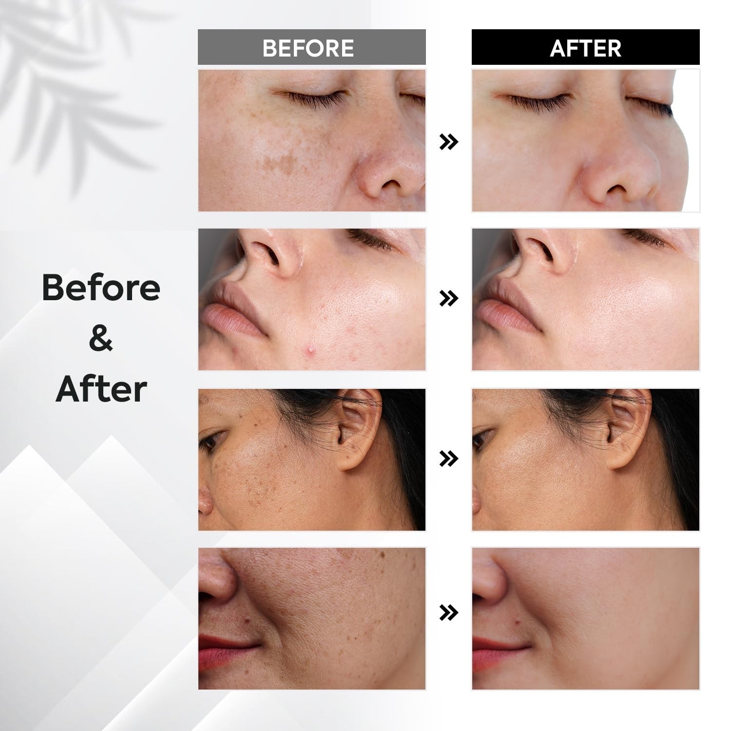Dark Spot Remover for Face and Body Musely Dark Spot Remover for Melasma Sun …