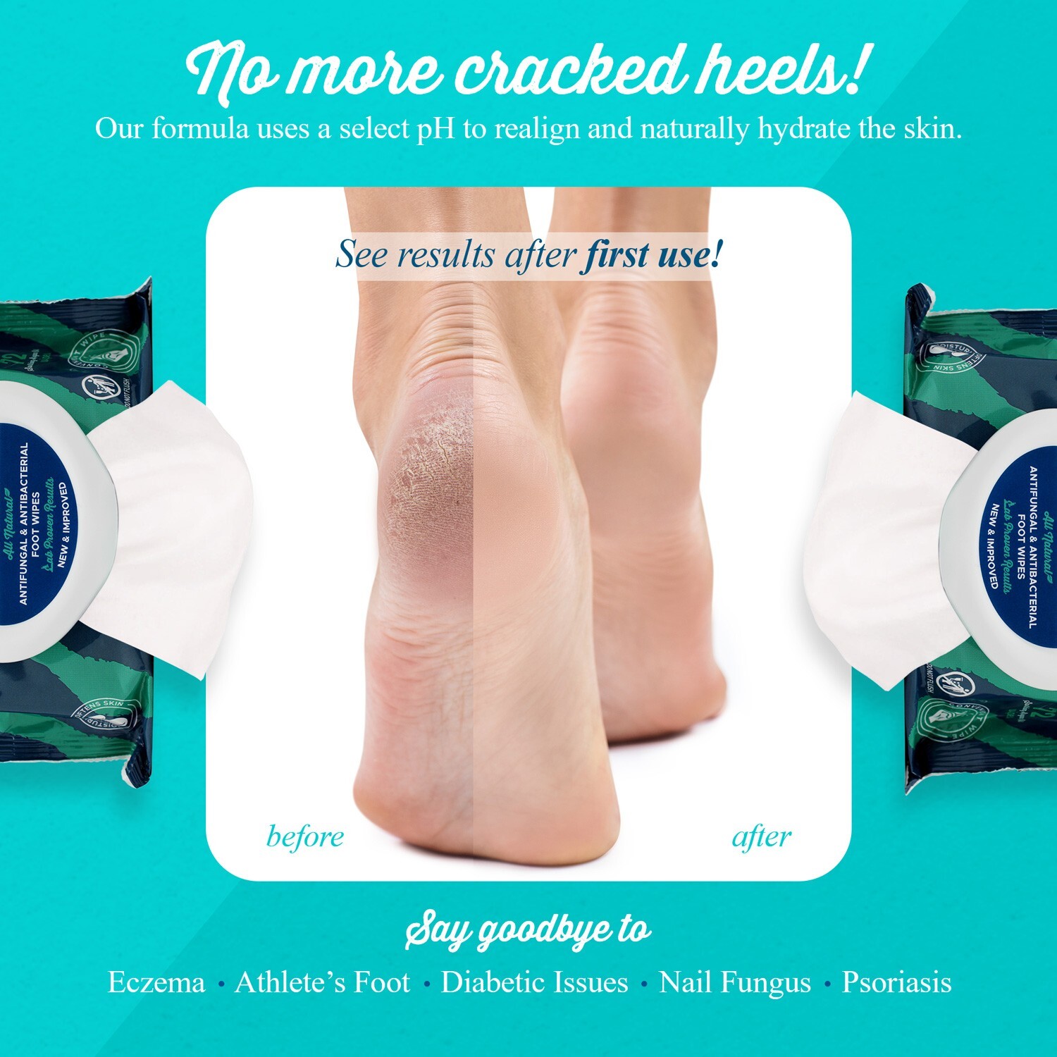 pHeet Wipes, Antifungal, Odor Reducer, Dry Feet Moisturizing Wipes, Foot Cleaner