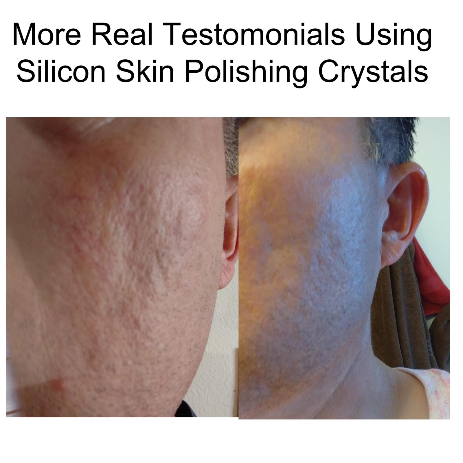 Acne Scars SILICON Skin Polishing Crystals Gel Indented Rolling Keloid ALKAVITA