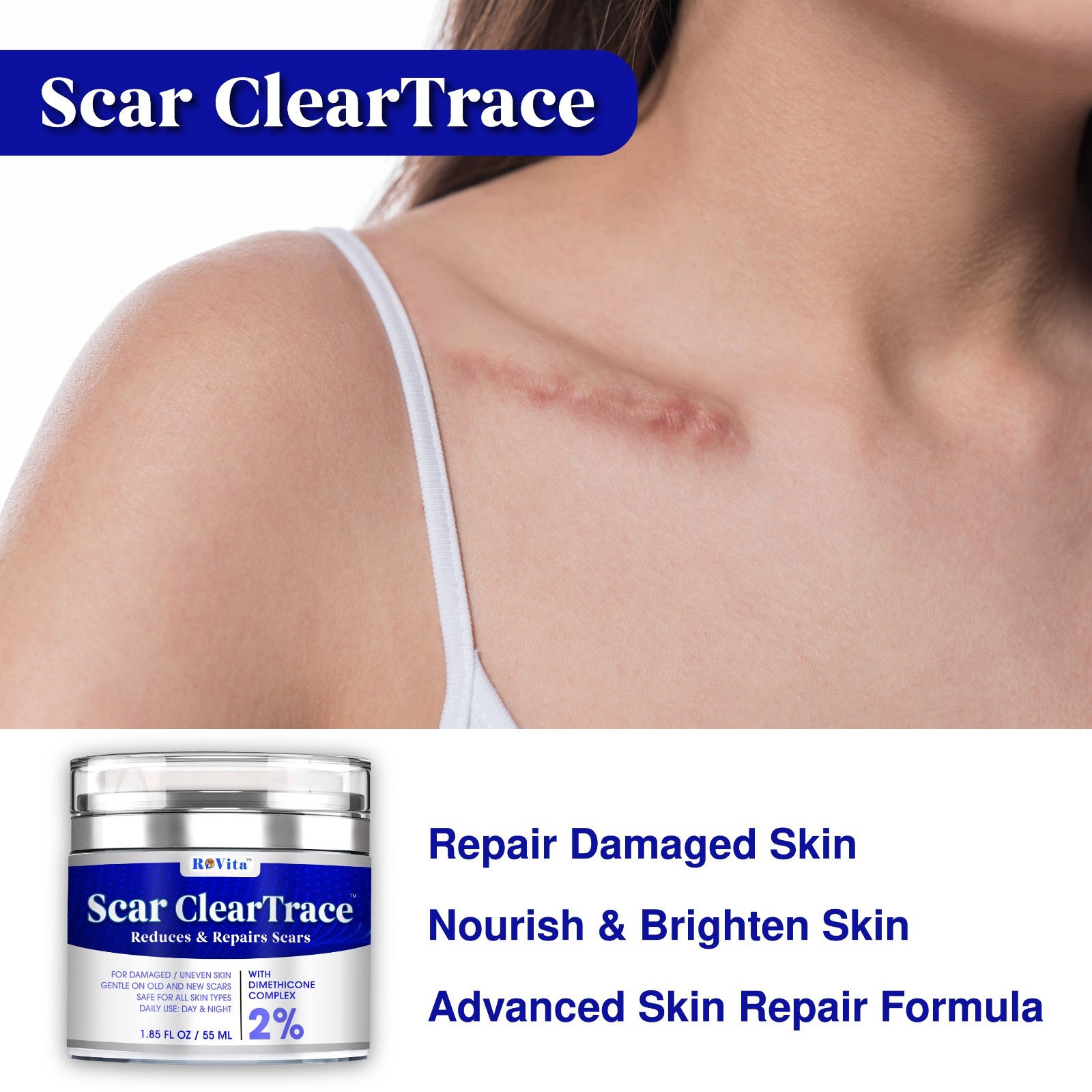 Scar Removal Cream – Old Scars Stretch Mark Spots, Surgery, Burn, Injury Scar