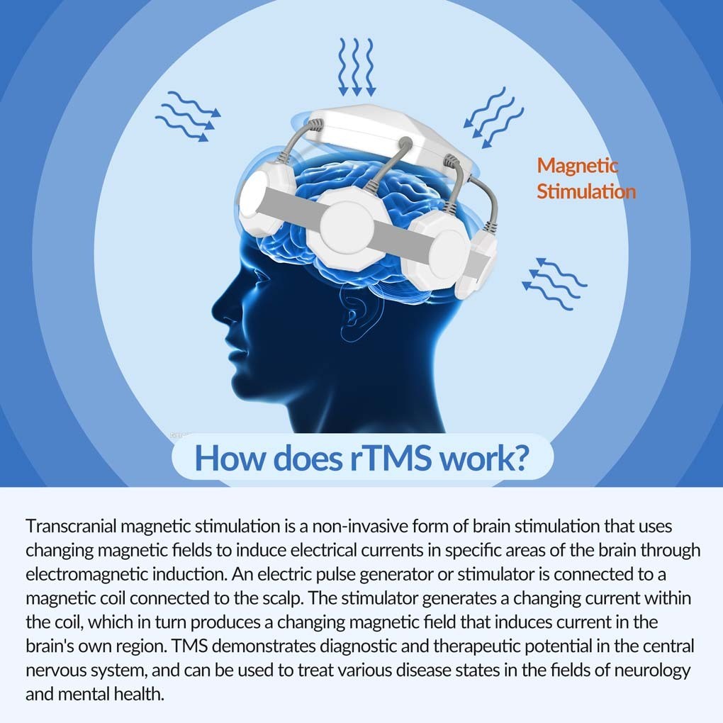 rTMS Transcranial Magnetic Clinical Neurostimulation for Resistant Depression