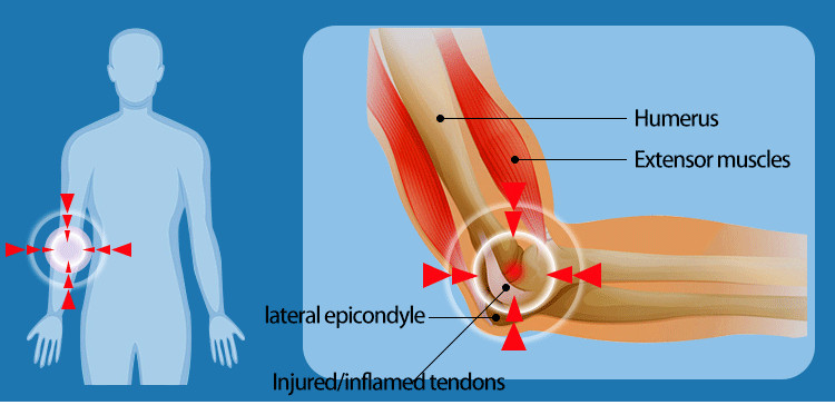 Professional Radial Pneumatic Shockwave Therapy Machine Pain Relief ED Treatment