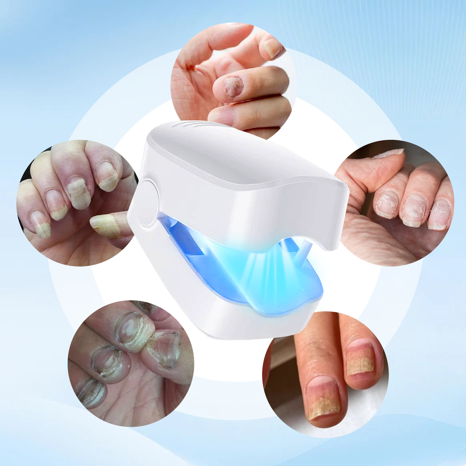 Nail Fungus Laser Physiotherapy Device 940nm 500nm for Toenail Fingernail Care