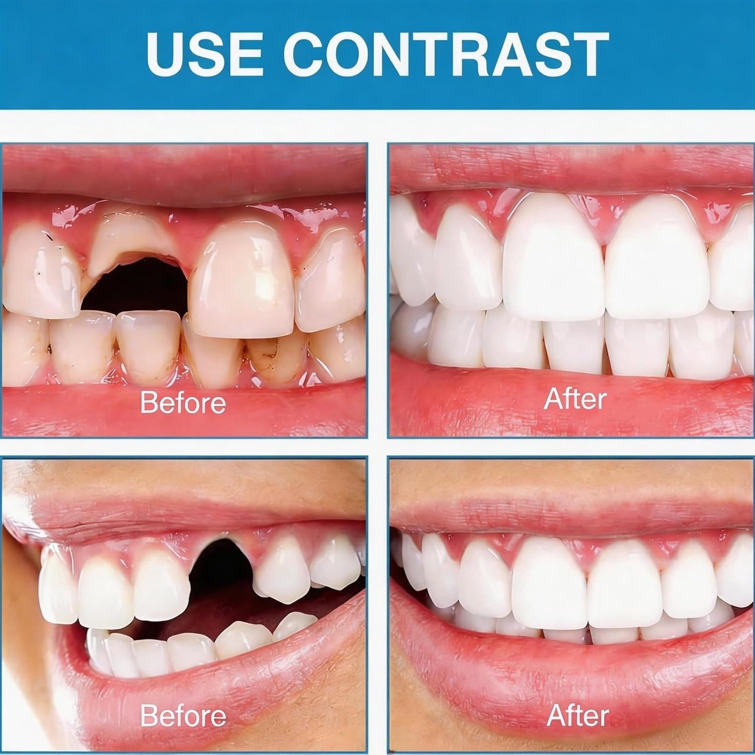 Smile Snap On Upper + Lower False Teeth Dental Veneers Denture Tooth Cover Set